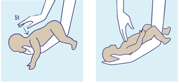 Determine if the infant can cry or cough. If not, proceed through steps to try to dislodge item.